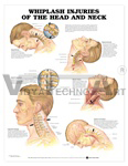 Whiplash Injuries of the Head and Neck Anatomical Chart